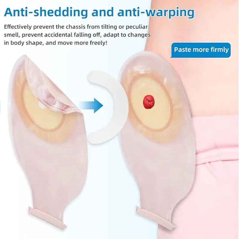 Medical Tape - 医療用オストミーバッグ補強ストリップ弾性感圧テープスパンレーステープ粘着フランジシールエクステンダーストリップ